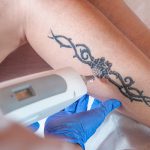 Tatueringsborttagning på ben