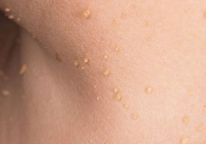 Fibrom Fibrom