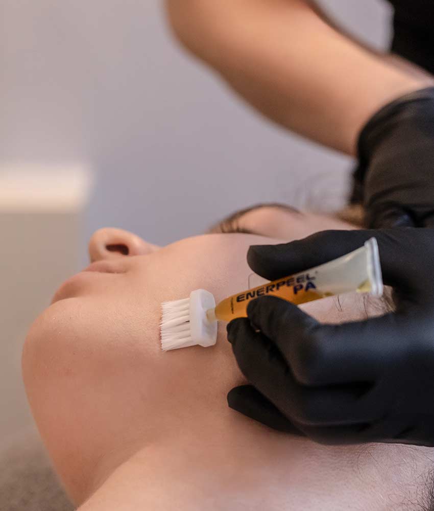 Kemisk peeling, Caroli Skönhetslounge Kemisk peeling, Caroli Skönhetslounge